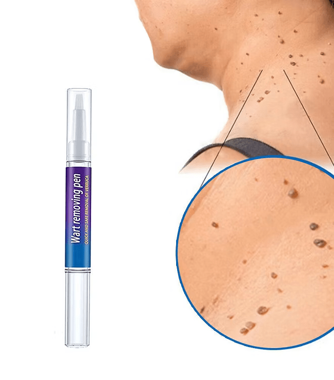 Advanced Herbal Wart Skin Tags Remover - Trendart