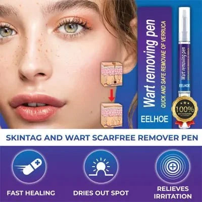 Advanced Herbal Wart Skin Tags Remover - Trendart