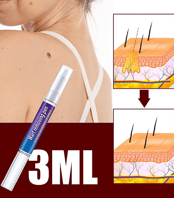 Advanced Herbal Wart Skin Tags Remover - Trendart