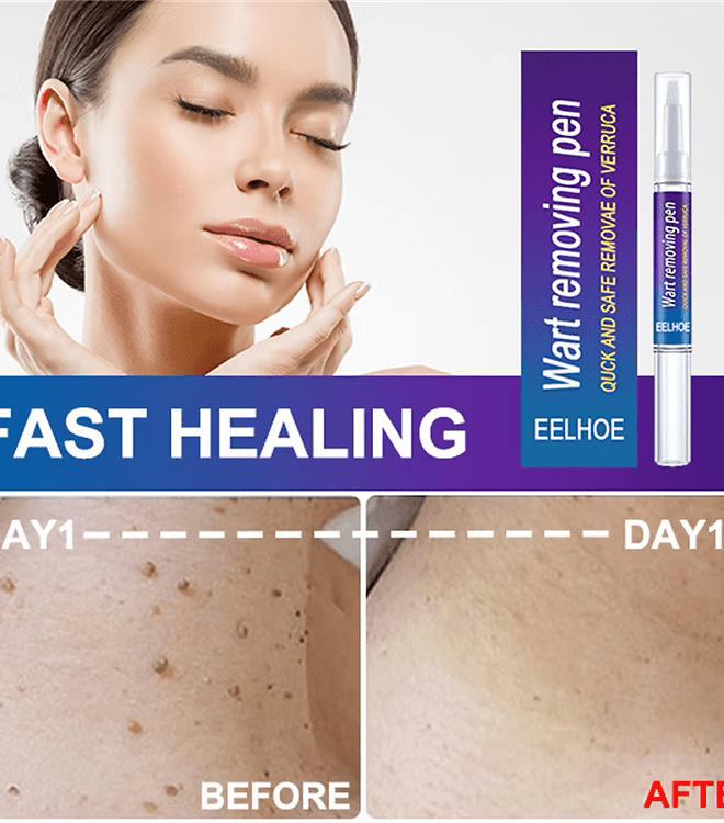 Advanced Herbal Wart Skin Tags Remover - Trendart