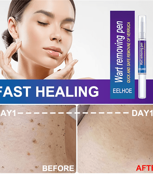 Advanced Herbal Wart Skin Tags Remover - Trendart