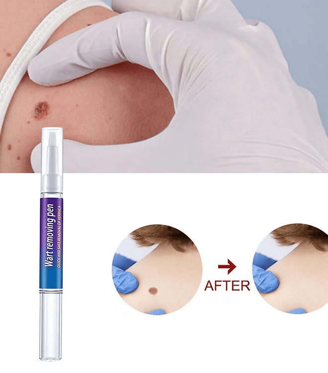 Advanced Herbal Wart Skin Tags Remover - Trendart